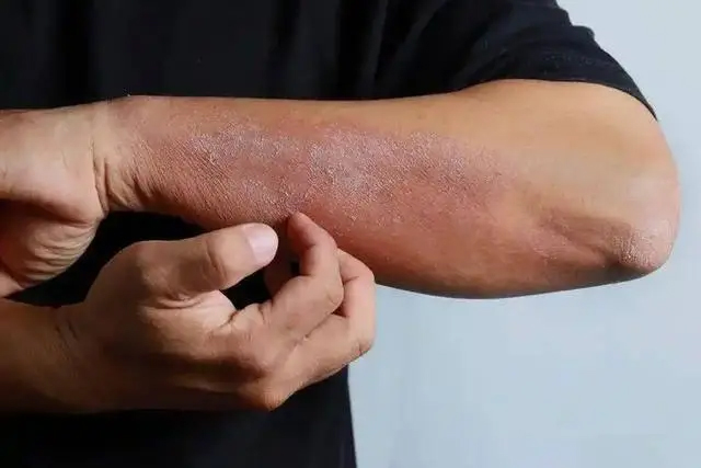 Người phụ nữ 44 tuổi bật khóc vì phát hiện tiểu đường muộn: “Tôi đã bỏ qua tín hiệu từ tay chân quá lâu” - Ảnh 3. Người phụ nữ 44 tuổi bật khóc vì phát hiện tiểu đường muộn: “Tôi đã bỏ qua tín hiệu từ tay chân quá lâu” - Ảnh 3.