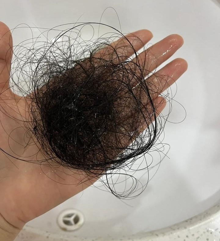 Đột nhiên tóc rụng từng mảng tới "hói trắng cả đầu", nữ sinh bàng hoàng khi nghe bác sĩ tiết lộ nguyên nhân - Ảnh 3. Đột nhiên tóc rụng từng mảng tới "hói trắng cả đầu", nữ sinh bàng hoàng khi nghe bác sĩ tiết lộ nguyên nhân - Ảnh 3.