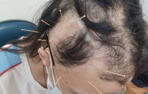 Đột nhiên tóc rụng từng mảng tới "hói trắng cả đầu", nữ sinh bàng hoàng khi nghe bác sĩ tiết lộ nguyên nhân - Ảnh 1. Đột nhiên tóc rụng từng mảng tới "hói trắng cả đầu", nữ sinh bàng hoàng khi nghe bác sĩ tiết lộ nguyên nhân - Ảnh 1.