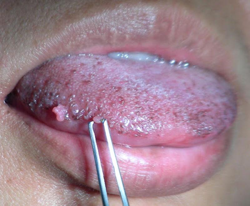 Nam giới tiêm vắc xin HPV thì phòng được những bệnh gì, nên tiêm loại nào? - Ảnh 1. Nam giới tiêm vắc xin HPV thì phòng được những bệnh gì, nên tiêm loại nào? - Ảnh 1.