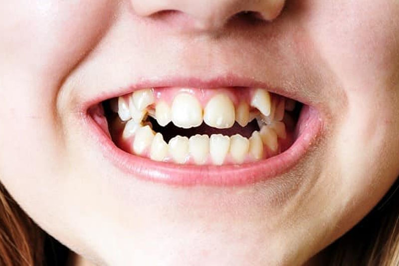 Bé gái 11 tuổi có 81 chiếc răng: Bác sĩ cũng sửng sốt vì số răng thừa nhiều gần bằng răng vĩnh viễn- Ảnh 4. Bé gái 11 tuổi có 81 chiếc răng: Bác sĩ cũng sửng sốt vì số răng thừa nhiều gần bằng răng vĩnh viễn- Ảnh 4.