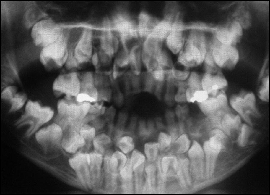 Bé gái 11 tuổi có 81 chiếc răng: Bác sĩ cũng sửng sốt vì số răng thừa nhiều gần bằng răng vĩnh viễn- Ảnh 2. Bé gái 11 tuổi có 81 chiếc răng: Bác sĩ cũng sửng sốt vì số răng thừa nhiều gần bằng răng vĩnh viễn- Ảnh 2.