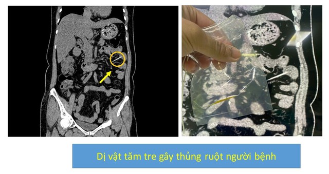thung-ruot-2-1752633530460-17526335307141044282774-1752643319256-17526433193821785637809.jpg