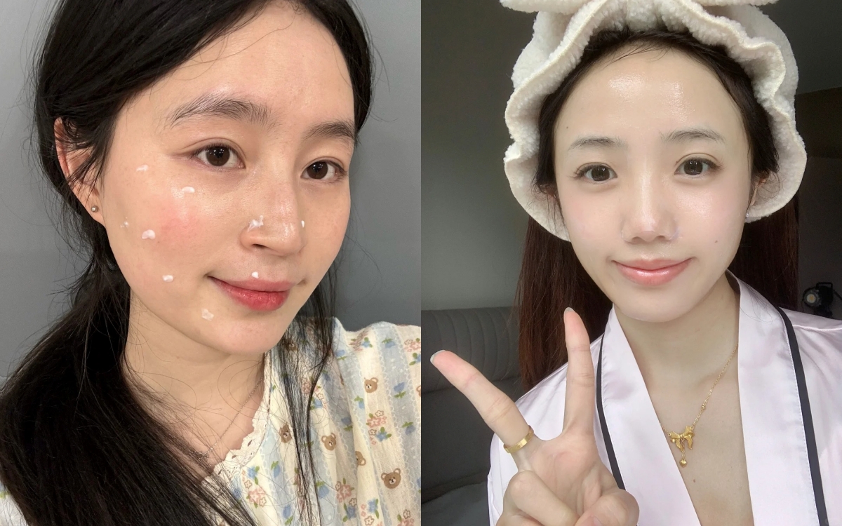 Làn da li ti mụn của tôi đã được cải thiện hoàn toàn nhờ 5 chiêu đơn giản - Ảnh 1. Làn da li ti mụn của tôi đã được cải thiện hoàn toàn nhờ 5 chiêu đơn giản - Ảnh 1.