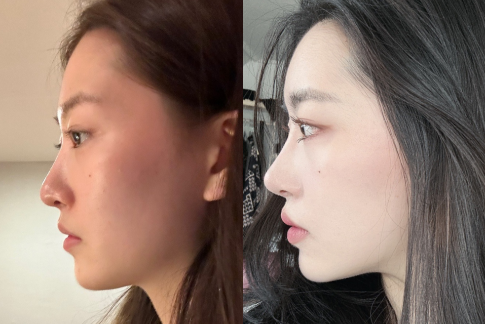 koreanplasticsurgerytrends28152920890930-1752749651774998269505-1752805629652-17528056297451784743782.png