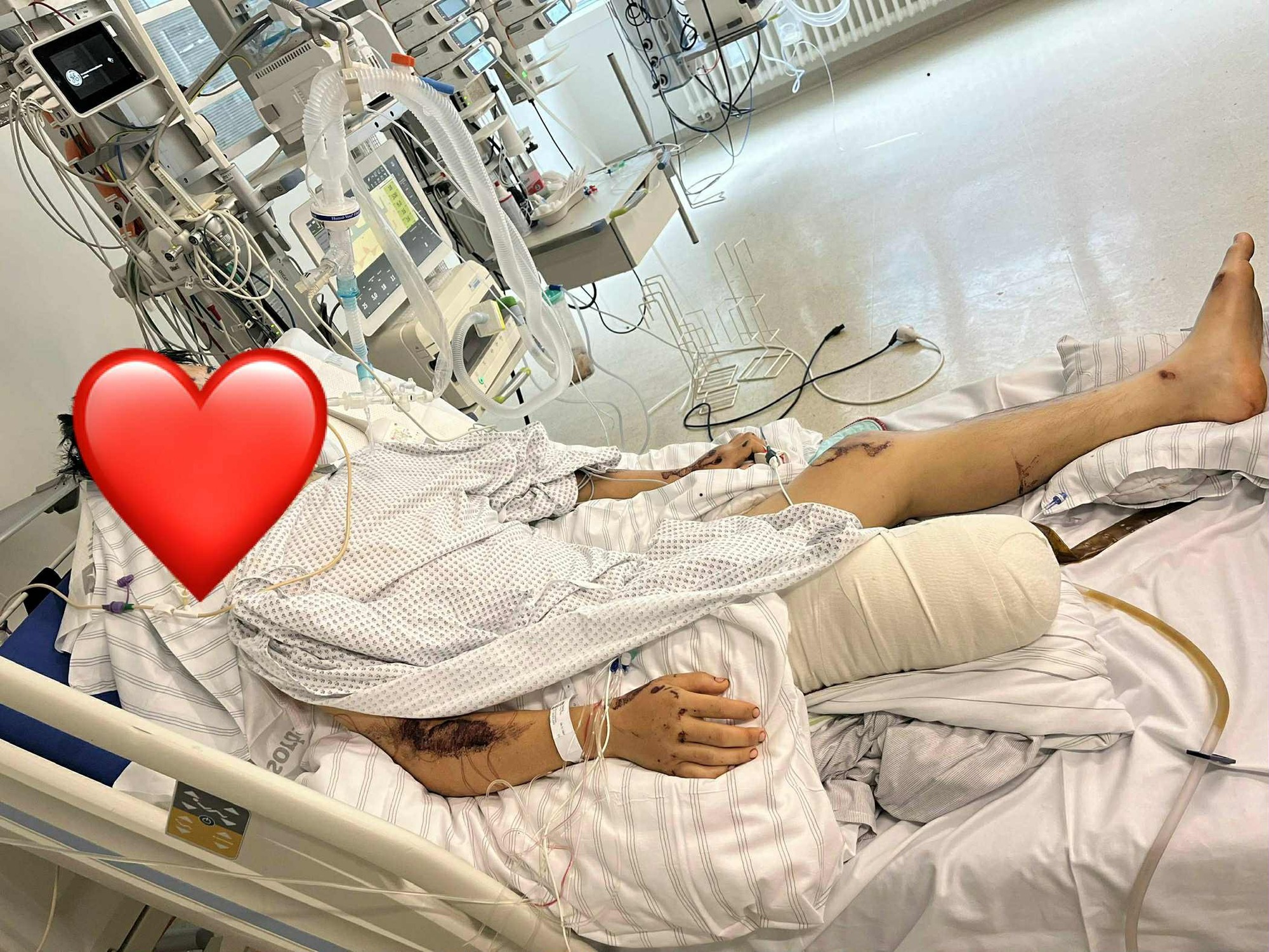 Du học sinh Việt gặp tai nạn nghiêm trọng tại Đức, người thân chia sẻ tình hình sau ca mổ não - Ảnh 2. Du học sinh Việt gặp tai nạn nghiêm trọng tại Đức, người thân chia sẻ tình hình sau ca mổ não - Ảnh 2.
