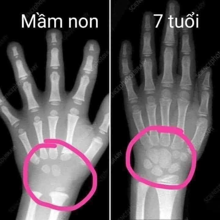 Tràn lan thông tin "trẻ mầm non tập viết sớm hại cho sự phát triển xương": Bác sĩ đính chính - Ảnh 2. Tràn lan thông tin "trẻ mầm non tập viết sớm hại cho sự phát triển xương": Bác sĩ đính chính - Ảnh 2.