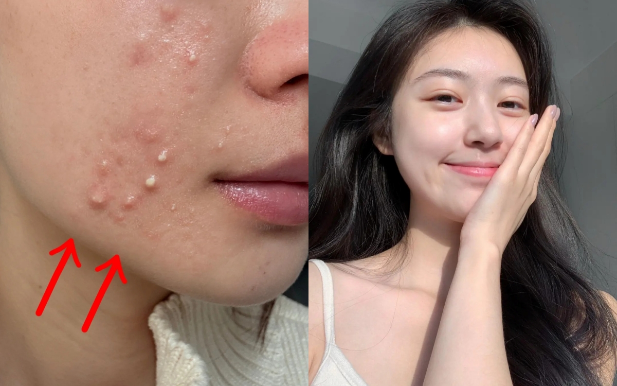 5 kem chấm mụn &quot;thần thánh&quot;: Vừa xẹp mụn vừa ngừa thâm hiệu quả - Ảnh 1.