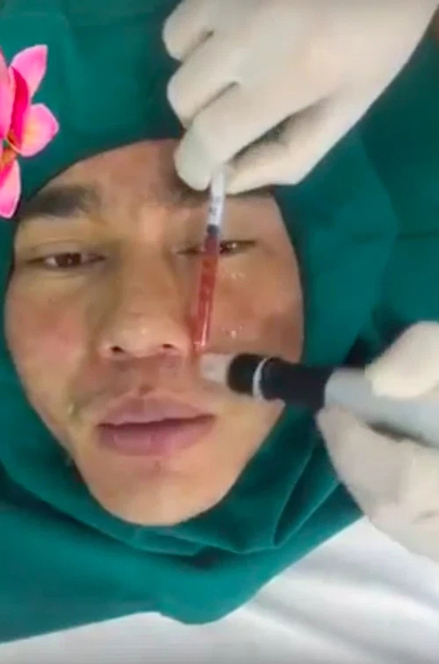 Sao nam Việt nghiện phẫu thuật thẩm mỹ: Từng cứ 10 ngày lại đi chỉnh sửa 1 lần, bị tụt sụn mũi khi đang chạy bộ - Ảnh 4.