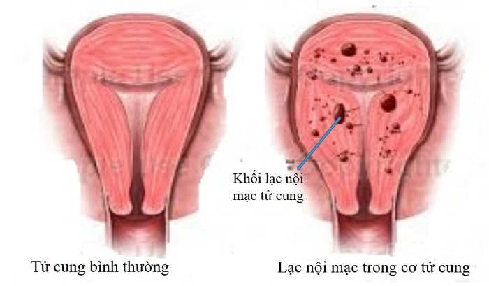 lac-noi-mc-tu-cung-17534361931401036471836-1753439510045-17534395101551626620797.jpg
