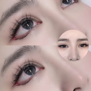 Trào lưu phẫu thuật thẩm mỹ dáng mắt minion ở Trung Quốc gây tranh luận, CĐM chỉ sợ mắt lúc ngủ khó mà nhắm lại được - Ảnh 4.