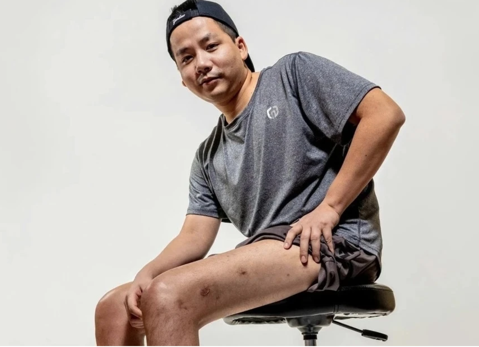 YouTuber &quot;giàu nhất Việt Nam&quot; chi gần 3 tỷ đồng để kéo chân dài thêm 7 cm: Bác sĩ nói gì? - Ảnh 1.