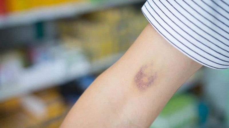 Lý do vitamin K có tác dụng chống lão hóa và dấu hiệu cho thấy bạn đang bị thiếu vitamin này: 2 độ tuổi đặc biệt cần bổ sung- Ảnh 5.