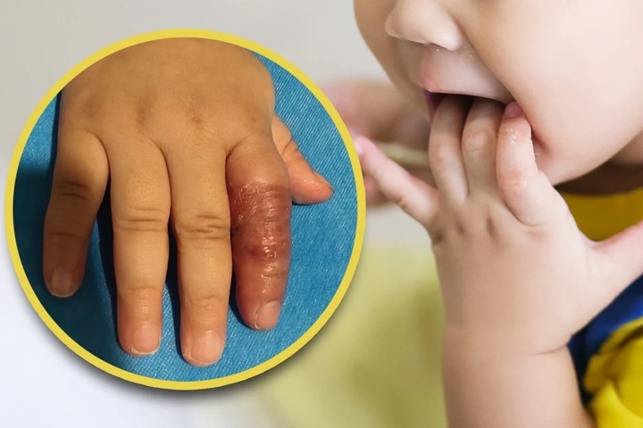 Mẹ dùng băng quấn để ngăn con mút tay, em bé suýt phải cắt cụt ngón - Ảnh 1. Mẹ dùng băng quấn để ngăn con mút tay, em bé suýt phải cắt cụt ngón - Ảnh 1.