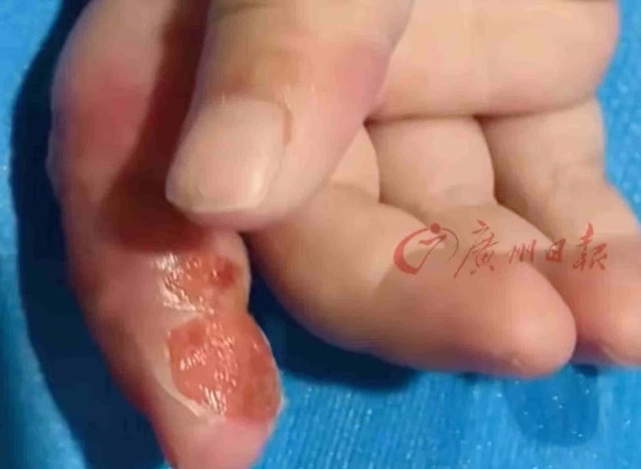 Mẹ dùng băng quấn để ngăn con mút tay, em bé suýt phải cắt cụt ngón - Ảnh 2. Mẹ dùng băng quấn để ngăn con mút tay, em bé suýt phải cắt cụt ngón - Ảnh 2.