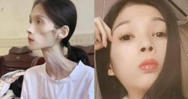 Hình ảnh cô gái 27 tuổi chỉ nặng 17kg vì viêm teo dạ dày gây xót xa: Căn bệnh không thể xem nhẹ, người trẻ cũng cần cảnh giác - Ảnh 2. Hình ảnh cô gái 27 tuổi chỉ nặng 17kg vì viêm teo dạ dày gây xót xa: Căn bệnh không thể xem nhẹ, người trẻ cũng cần cảnh giác - Ảnh 2.