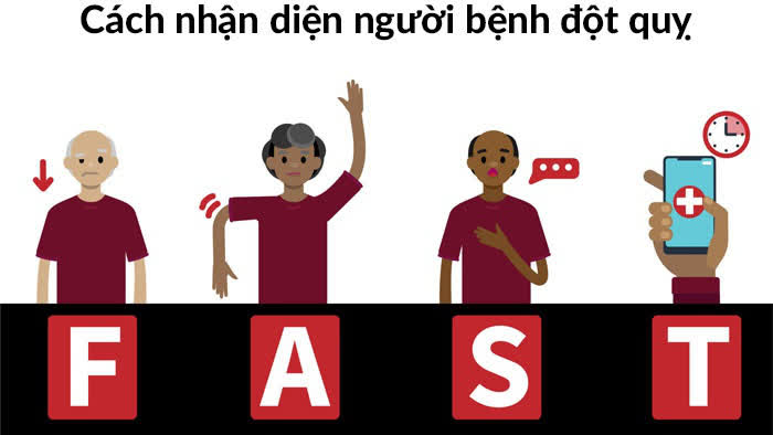 Ngày càng nhiều người trẻ bị đột quỵ: Cảnh báo những dấu hiệu đột quỵ khi ngủ, người khỏe mạnh cũng không được chủ quan- Ảnh 3. Ngày càng nhiều người trẻ bị đột quỵ: Cảnh báo những dấu hiệu đột quỵ khi ngủ, người khỏe mạnh cũng không được chủ quan- Ảnh 3.