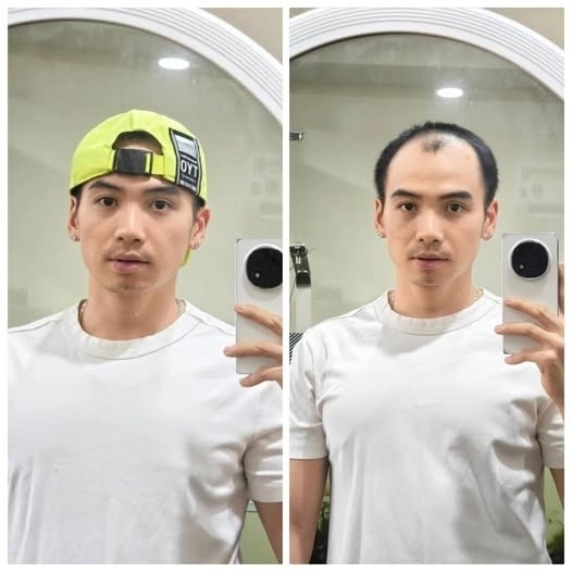 Chồng H'Hen Niê thay đổi thế nào sau cấy tóc trị hói đầu? Phương pháp này có giá bao nhiêu? - Ảnh 2. Chồng H'Hen Niê thay đổi thế nào sau cấy tóc trị hói đầu? Phương pháp này có giá bao nhiêu? - Ảnh 2.