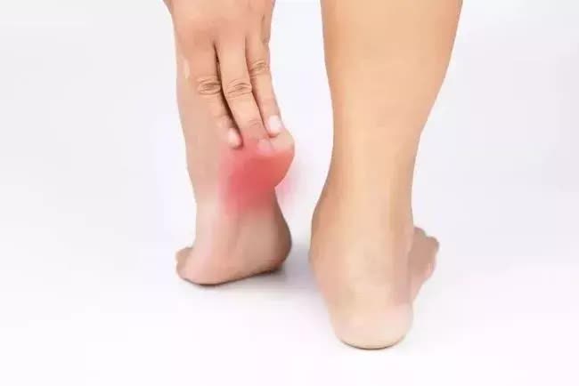 Nhìn bàn chân không có 2 dấu hiệu này thì thận của bạn đang rất tốt, nếu thấy đâu ở 2 vị trí thì nên đi khám thận ngay- Ảnh 3. Nhìn bàn chân không có 2 dấu hiệu này thì thận của bạn đang rất tốt, nếu thấy đâu ở 2 vị trí thì nên đi khám thận ngay- Ảnh 3.