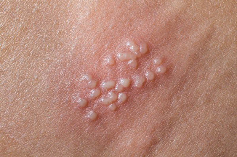 Mụn cóc sinh dục là gì, tiêm vắc xin HPV loại nào mới phòng chống được? - Ảnh 1. Mụn cóc sinh dục là gì, tiêm vắc xin HPV loại nào mới phòng chống được? - Ảnh 1.