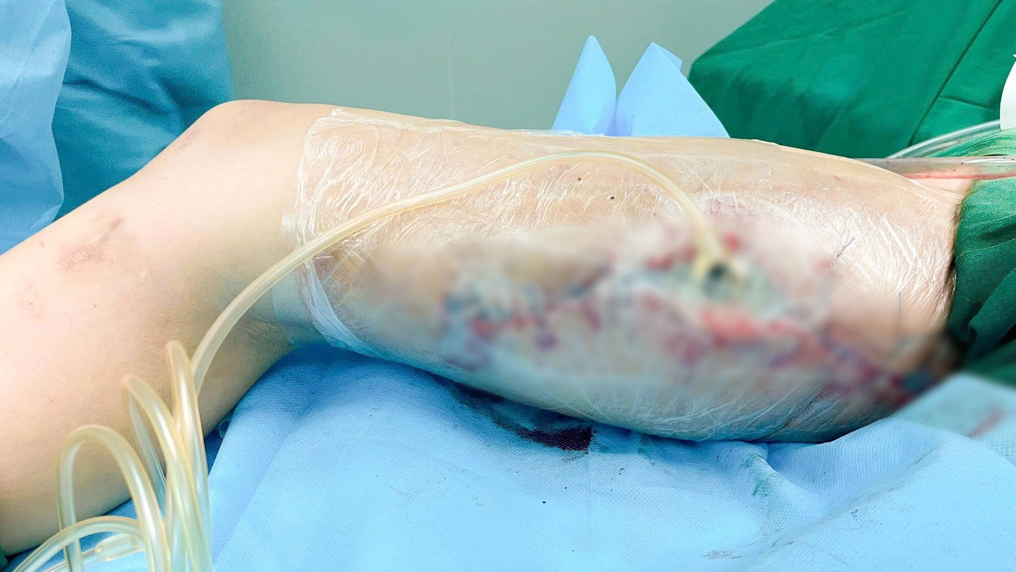 Ti&ecirc;m filler to&agrave;n th&acirc;n, c&ocirc; g&aacute;i trẻ hoại tử đ&ugrave;i, trải qua 60 ca mổ kh&oacute;c l&oacute;c cầu cứu b&aacute;c sĩ: "Kh&acirc;u lại gi&uacute;p, con đau lắm" - Ảnh 1.