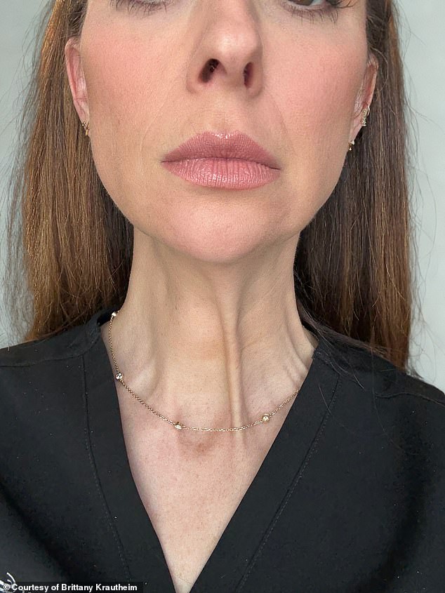 Tiêm botox vào một nửa khuôn mặt để xem ảnh hưởng thế nào đến vẻ bề ngoài: Nữ y tá Tiêm botox vào một nửa khuôn mặt để xem ảnh hưởng thế nào đến vẻ bề ngoài: Nữ y tá