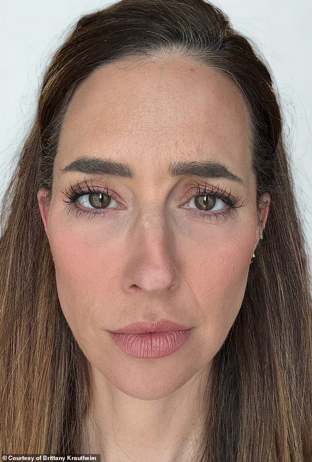 Tiêm botox vào một nửa khuôn mặt để xem ảnh hưởng thế nào đến vẻ bề ngoài: Nữ y tá Tiêm botox vào một nửa khuôn mặt để xem ảnh hưởng thế nào đến vẻ bề ngoài: Nữ y tá