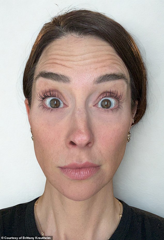 Tiêm botox vào một nửa khuôn mặt để xem ảnh hưởng thế nào đến vẻ bề ngoài: Nữ y tá Tiêm botox vào một nửa khuôn mặt để xem ảnh hưởng thế nào đến vẻ bề ngoài: Nữ y tá