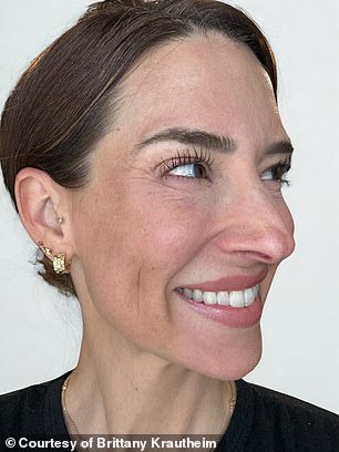 Tiêm botox vào một nửa khuôn mặt để xem ảnh hưởng thế nào đến vẻ bề ngoài: Nữ y tá Tiêm botox vào một nửa khuôn mặt để xem ảnh hưởng thế nào đến vẻ bề ngoài: Nữ y tá