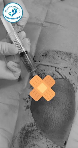 B&eacute; 6 tuổi bị vi&ecirc;m mủ khớp gối v&agrave; vi&ecirc;m xương tủy sau va đập: BS cảnh b&aacute;o chấn thương k&iacute;n của trẻ c&oacute; thể tiềm ẩn nhiều nguy cơ hơn bố mẹ nghĩ- Ảnh 2.