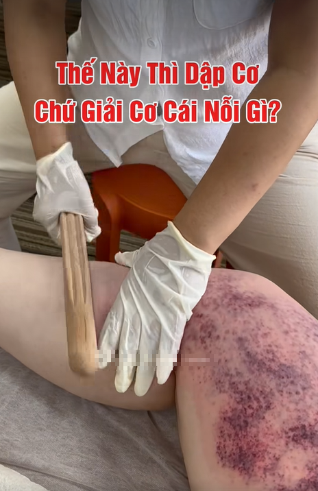 Rùng mình xem clip giải cơ lan truyền MXH, cận cảnh da thịt bị đập bầm tím ai nấy sợ hãi, xót xa - Ảnh 1. Rùng mình xem clip giải cơ lan truyền MXH, cận cảnh da thịt bị đập bầm tím ai nấy sợ hãi, xót xa - Ảnh 1.