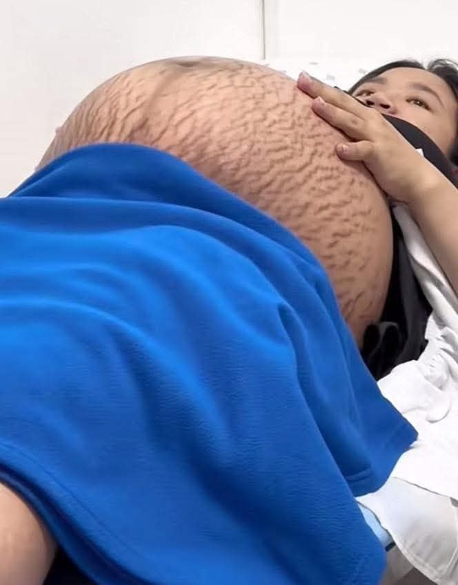 Xót xa hình ảnh chiếc bụng rạn nứt chằng chịt như dưa bở của mẹ bầu thai đôi ở tuần thứ 36- Ảnh 3.