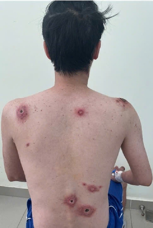 Nam nhân viên văn phòng lở loét toàn thân vì quan hệ tình dục bừa bãi - Ảnh 1. Nam nhân viên văn phòng lở loét toàn thân vì quan hệ tình dục bừa bãi - Ảnh 1.