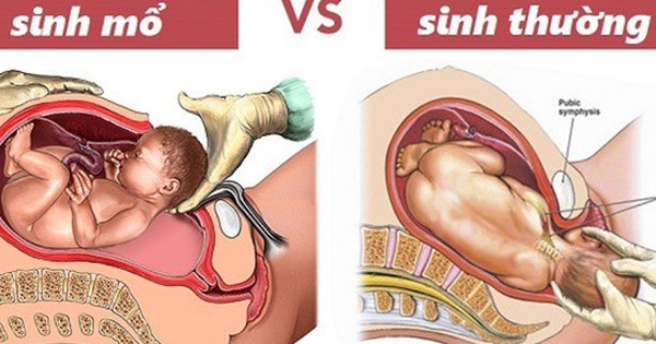 Chọn giờ sinh mổ để được &quot;giờ tốt, ngày tốt&quot;: Những rủi ro ít mẹ lường được