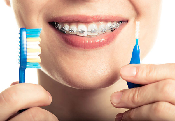 Những sai lầm trong chăm sóc răng miệng khi đang niềng: Cẩn trọng kẻo 
