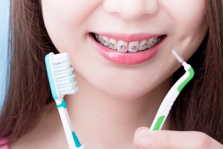 Những sai lầm trong chăm sóc răng miệng khi đang niềng: Cẩn trọng kẻo 
