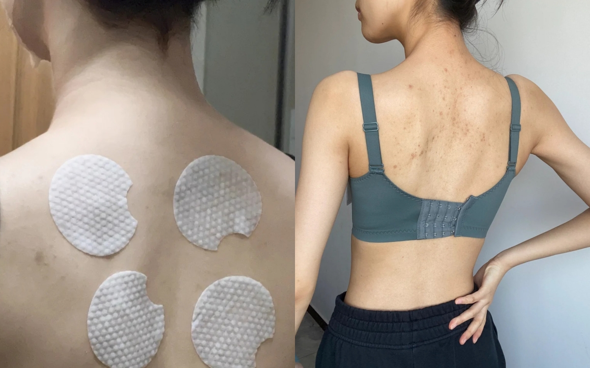 Từ mụn lưng sần sùi, tôi đã thay đổi hoàn toàn nhờ món đồ rẻ tiền - Ảnh 1.