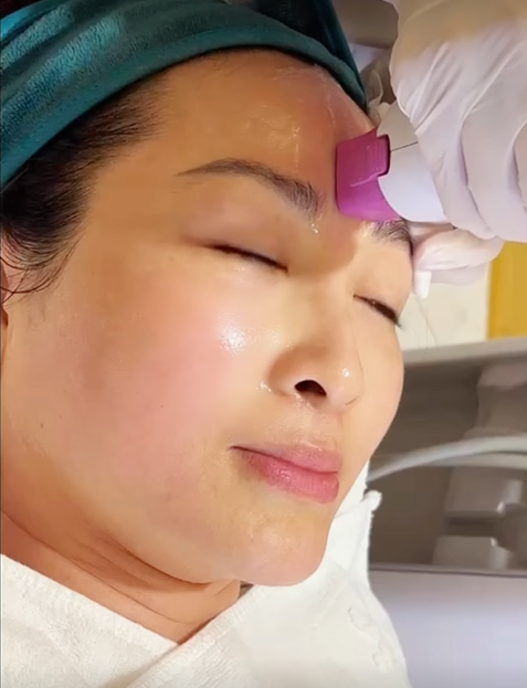 khanh-huyen-lam-thermage1-17556726965281350814905.png