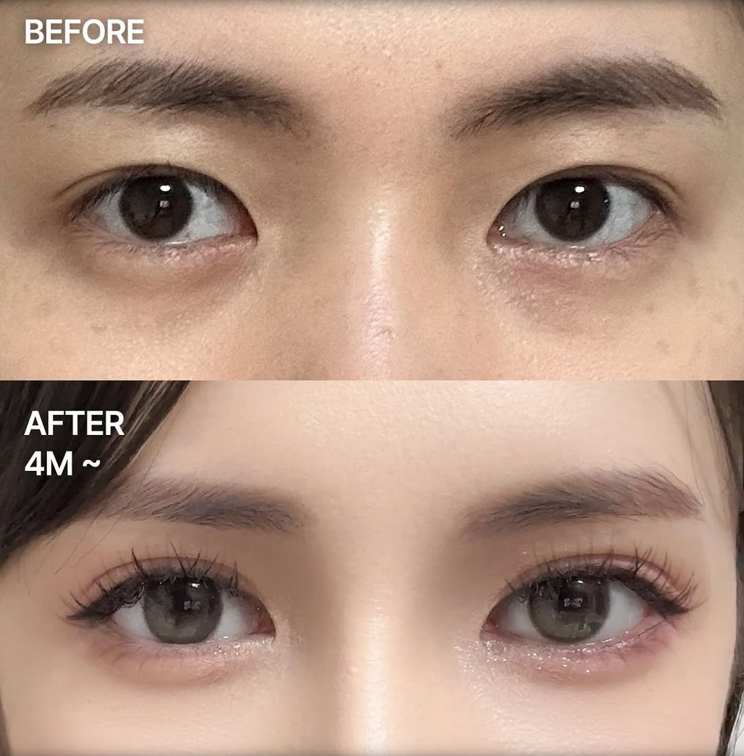 5 điều bạn cần biết trước khi quyết định nâng mũi Hàn Quốc - Ảnh 3. 5 điều bạn cần biết trước khi quyết định nâng mũi Hàn Quốc - Ảnh 3.
