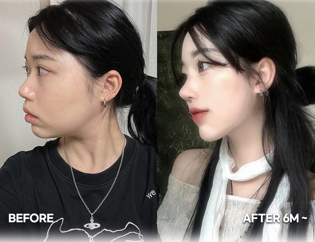 5 điều bạn cần biết trước khi quyết định nâng mũi Hàn Quốc - Ảnh 4. 5 điều bạn cần biết trước khi quyết định nâng mũi Hàn Quốc - Ảnh 4.