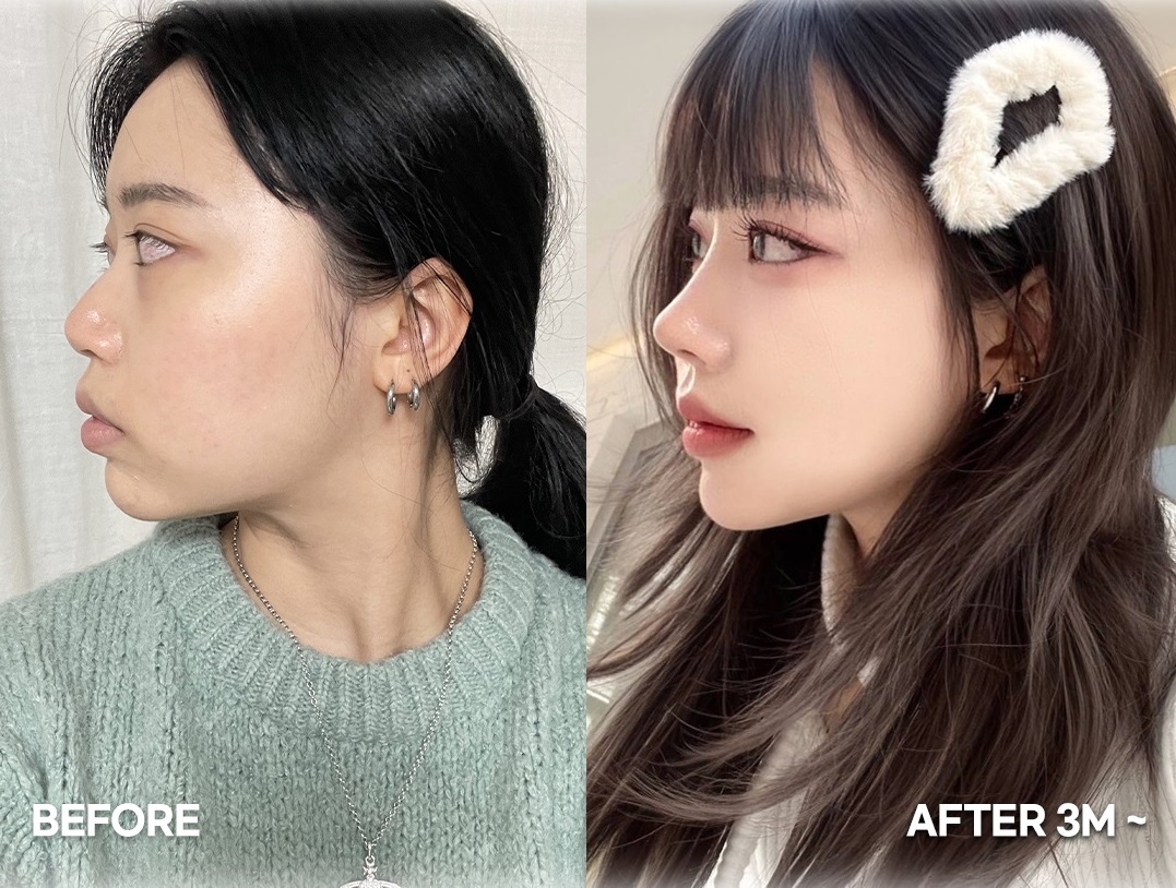5 điều bạn cần biết trước khi quyết định nâng mũi Hàn Quốc - Ảnh 5. 5 điều bạn cần biết trước khi quyết định nâng mũi Hàn Quốc - Ảnh 5.
