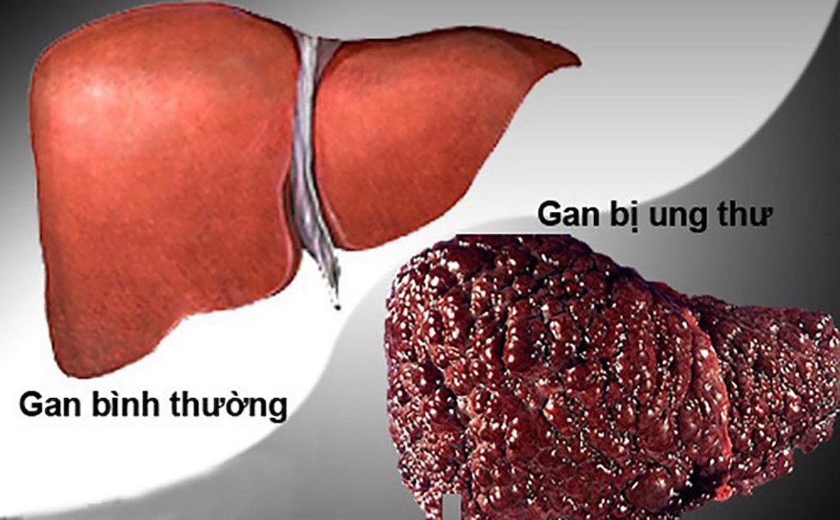 2 dấu hiệu ngứa ngáy cảnh báo UNG THƯ GAN nhưng nhiều người NHẦM là dị ứng - Ảnh 1. 2 dấu hiệu ngứa ngáy cảnh báo UNG THƯ GAN nhưng nhiều người NHẦM là dị ứng - Ảnh 1.