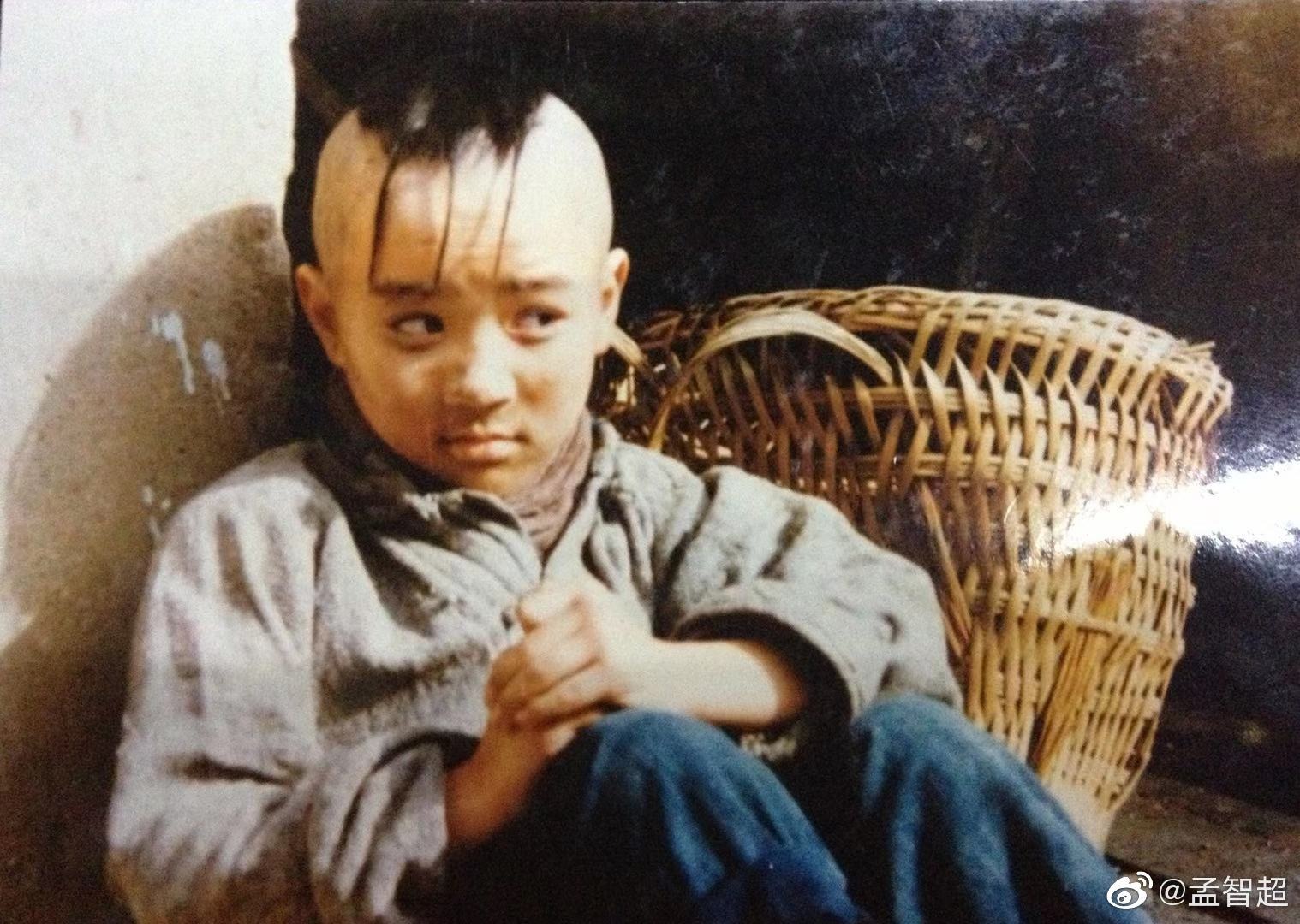 "Sao nhí số 1 showbiz" 14 tuổi đầu không còn 1 sợi tóc, khổ sở chịu đựng 300 mũi kim để cứu diện mạo- Ảnh 3. "Sao nhí số 1 showbiz" 14 tuổi đầu không còn 1 sợi tóc, khổ sở chịu đựng 300 mũi kim để cứu diện mạo- Ảnh 3.