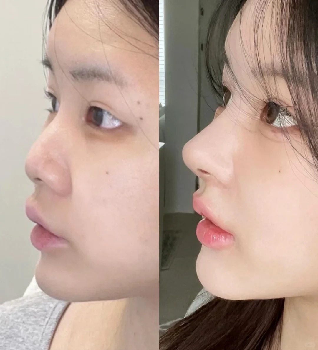 Nâng mũi giá rẻ: Những rủi ro tiềm ẩn và lời khuyên từ chuyên gia - Ảnh 4. Nâng mũi giá rẻ: Những rủi ro tiềm ẩn và lời khuyên từ chuyên gia - Ảnh 4.