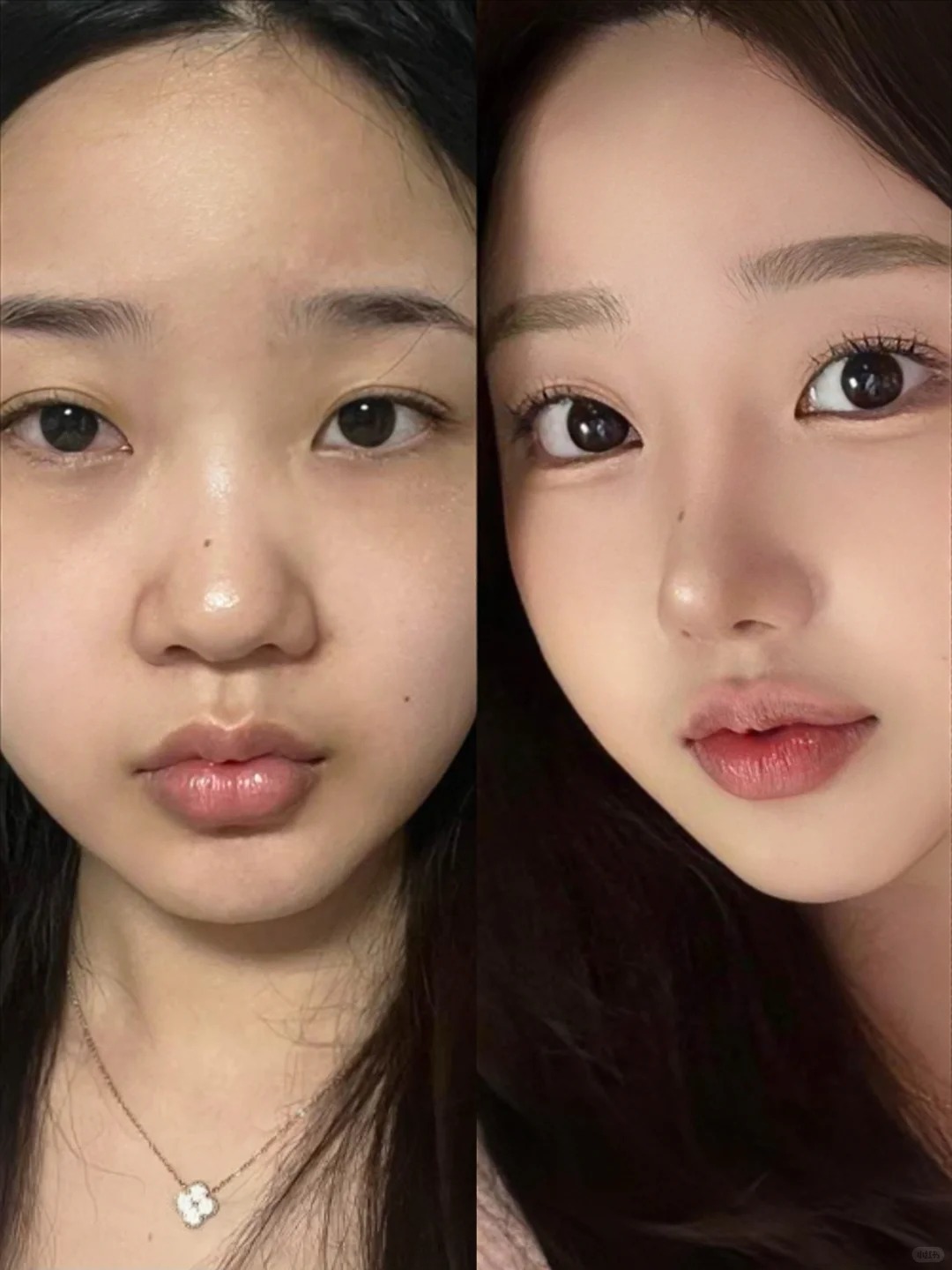 Nâng mũi giá rẻ: Những rủi ro tiềm ẩn và lời khuyên từ chuyên gia - Ảnh 2. Nâng mũi giá rẻ: Những rủi ro tiềm ẩn và lời khuyên từ chuyên gia - Ảnh 2.
