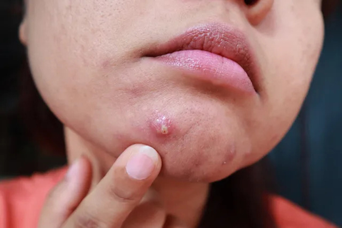 CẢNH BÁO: 4 kiểu mụn rất dễ là &quot;lớp ngụy trang&quot; của bệnh ung thư nhưng ít người để ý - Ảnh 4.