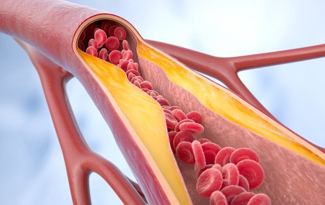 atherosclerosis-disease-cholesterol-blood-vessels-1756128720278315800130-1756171703327-17561717035781785459165.jpg