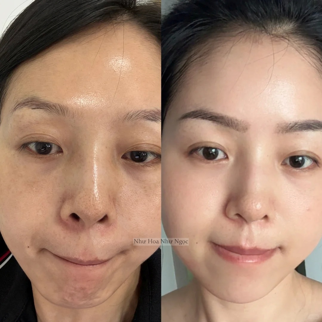 Blogger làm mờ thâm nám nhờ 2 năm tự dưỡng da kiên trì tại nhà - Ảnh 3.