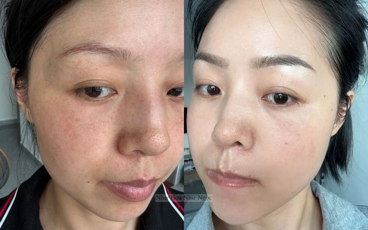 Blogger làm mờ thâm nám nhờ 2 năm tự dưỡng da kiên trì tại nhà - Ảnh 2.