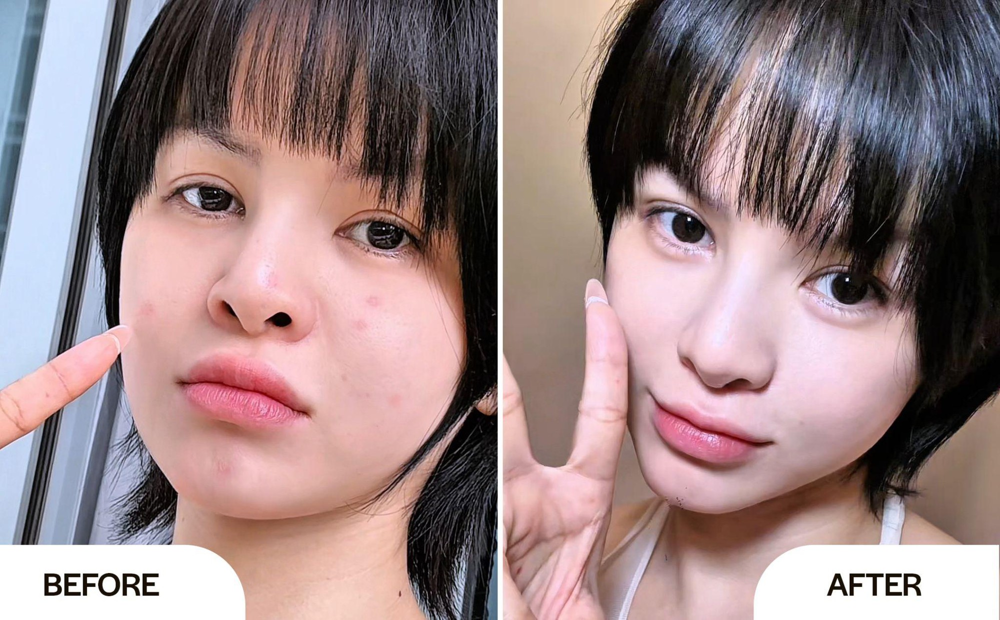 Serum Neutidi Niacinamide 10% có thật sự cải thiện làn da mụn và thâm sạm?- Ảnh 5. Serum Neutidi Niacinamide 10% có thật sự cải thiện làn da mụn và thâm sạm?- Ảnh 5.